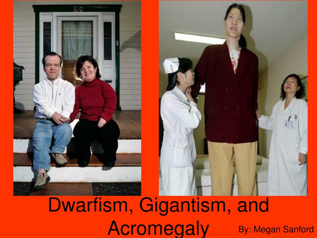 Pituitary Gigantism Vs Acromegaly