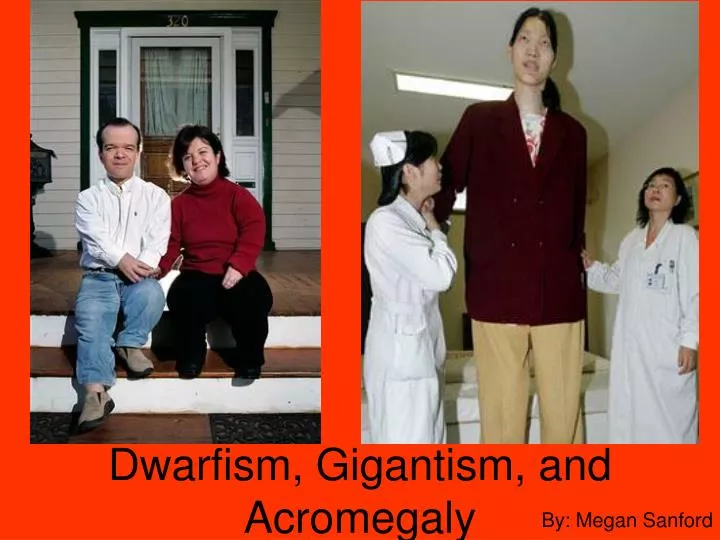 dwarfism gigantism and acromegaly n.