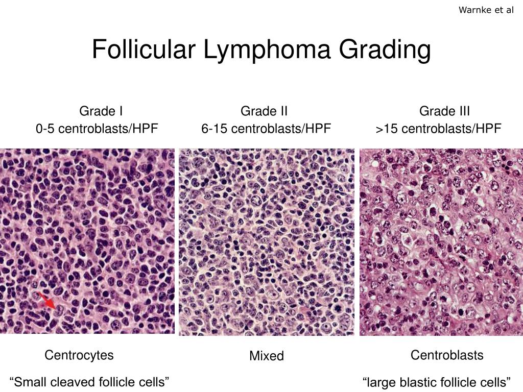PPT Follicular Lymphoma PowerPoint Presentation Free Download ID 