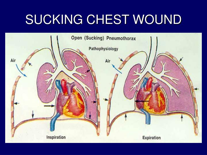 PPT CHEST TRAUMA PowerPoint Presentation ID1438644