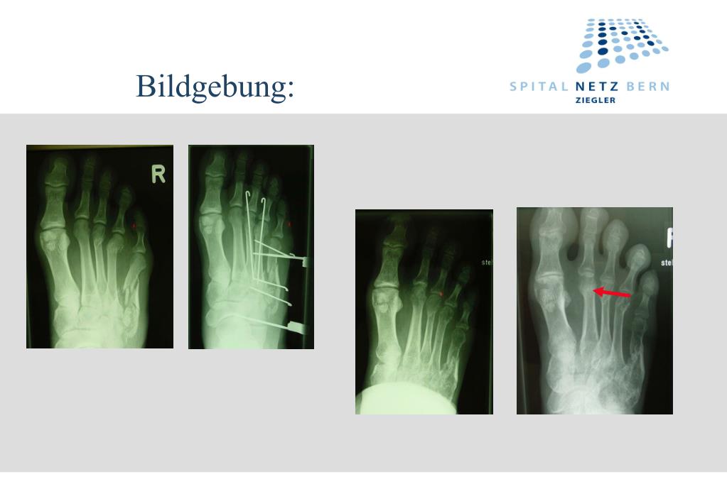 PPT - Stress Fractures: Causes, Symptoms, and Treatment Options ...