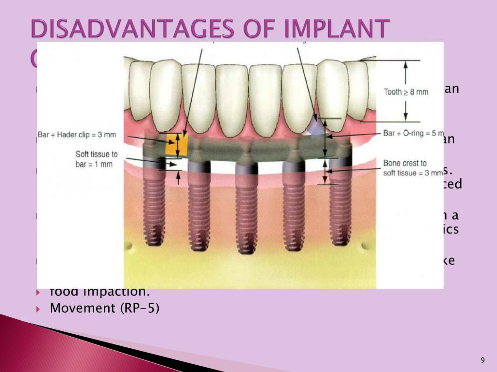 Universal Guide Sleeve Guided Drill External Irrigation Dental Implant  Depth | eBay