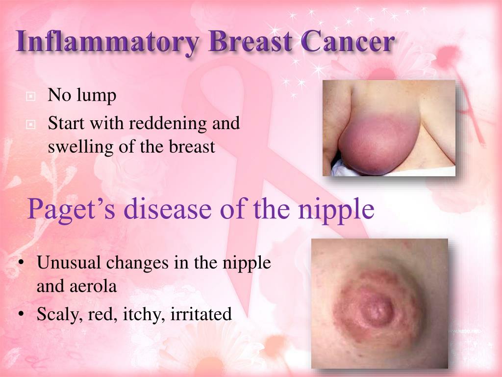 Breast Cancer : Symptoms and Signs. Lets bust the myth 