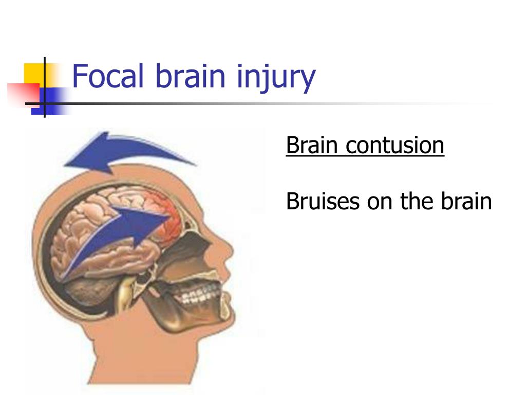 Ppt Head Injury Powerpoint Presentation Free Download Id1451492