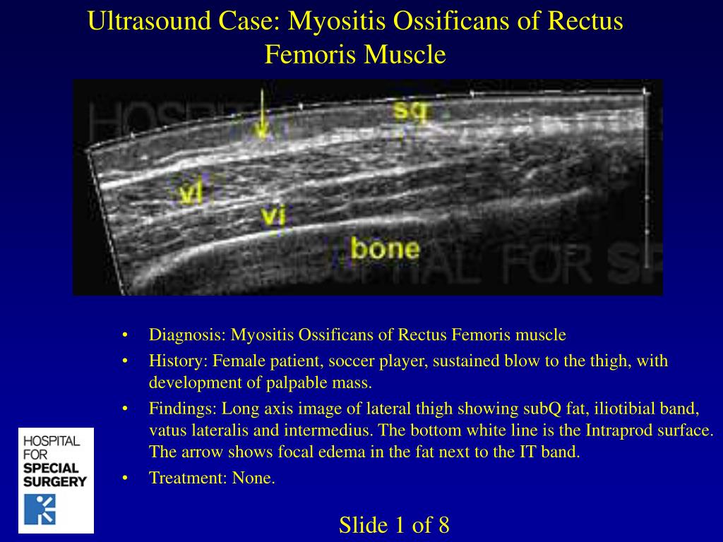 PPT - Ultrasound Case: Myositis Ossificans of Rectus Femoris Muscle