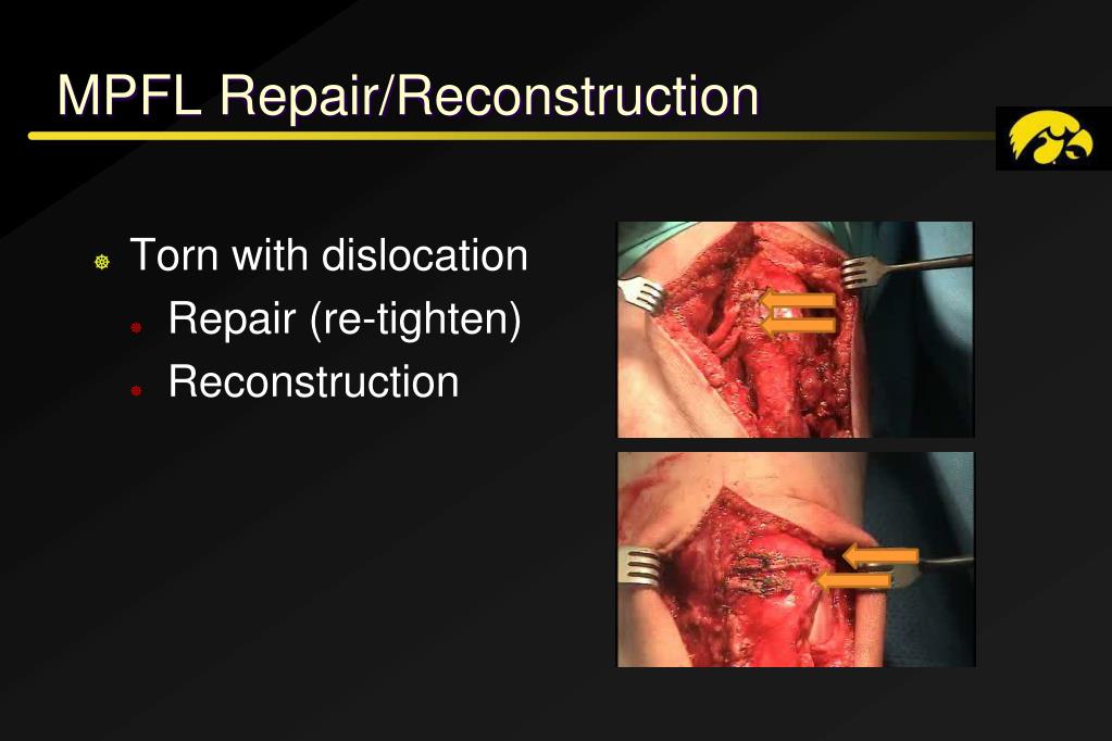 MPFL Repair/Reconstruction.