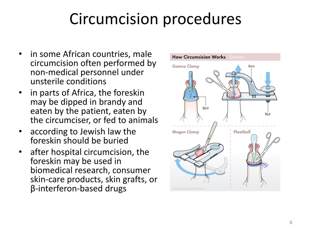 PPT Circumcision Vasectomy PowerPoint Presentation Free Download ID