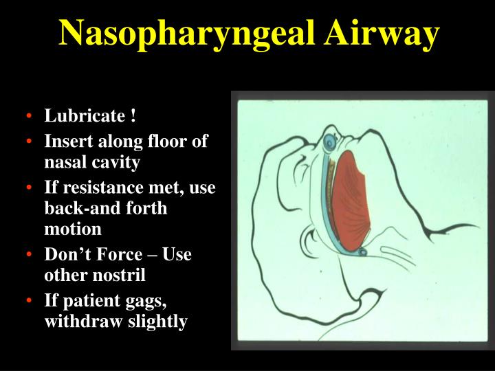 PPT - AIRWAY MANAGEMENT PowerPoint Presentation - ID:145745