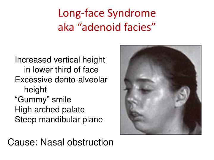 Long Narrow Face Syndrome
