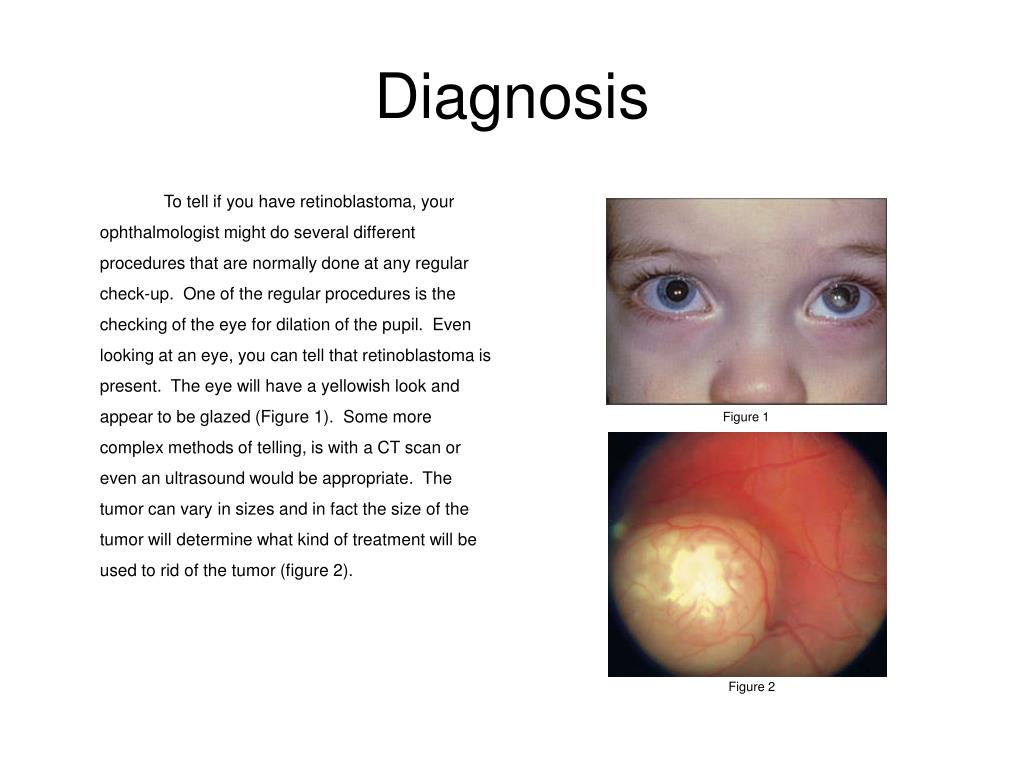 retinoblastoma punnett square