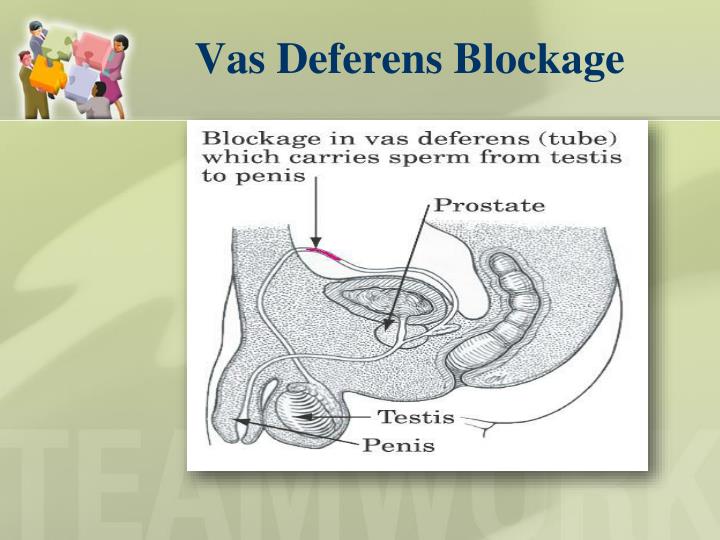 Vas deferens sperm blockage Vas deferens sperm blockage