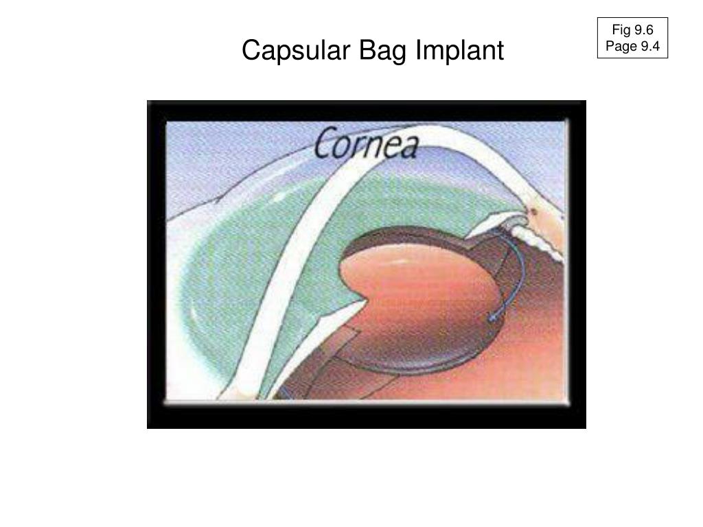 Capsular bag implantation of the intraocular lens after... | Download  Scientific Diagram