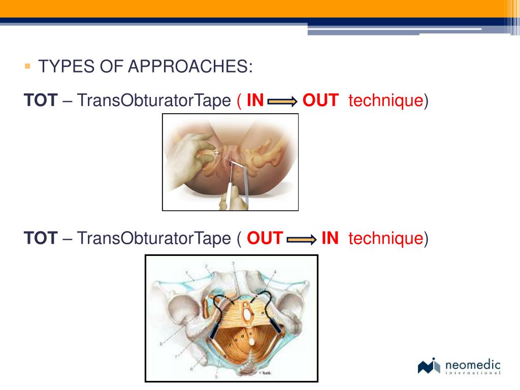 PPT - TVT PROCEDURE – TOT PROCEDURE PowerPoint Presentation, free download  - ID:1486713