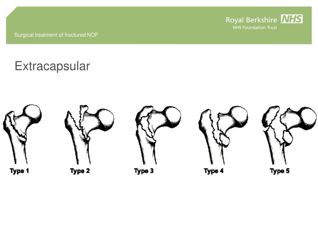 PPT Comprehensive Surgical Treatment Of Fractured Hip Neck Of Femur 