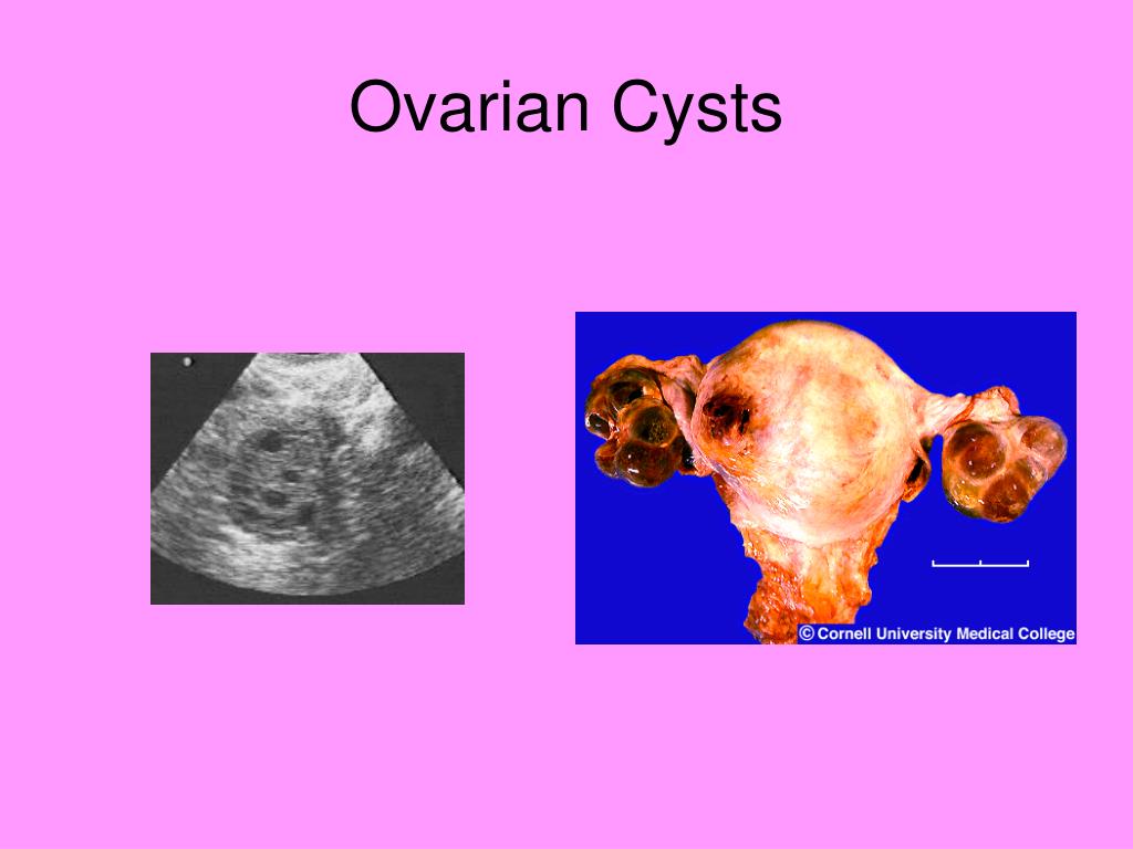 Ppt Reproductive System Disorders Powerpoint Presentation Free
