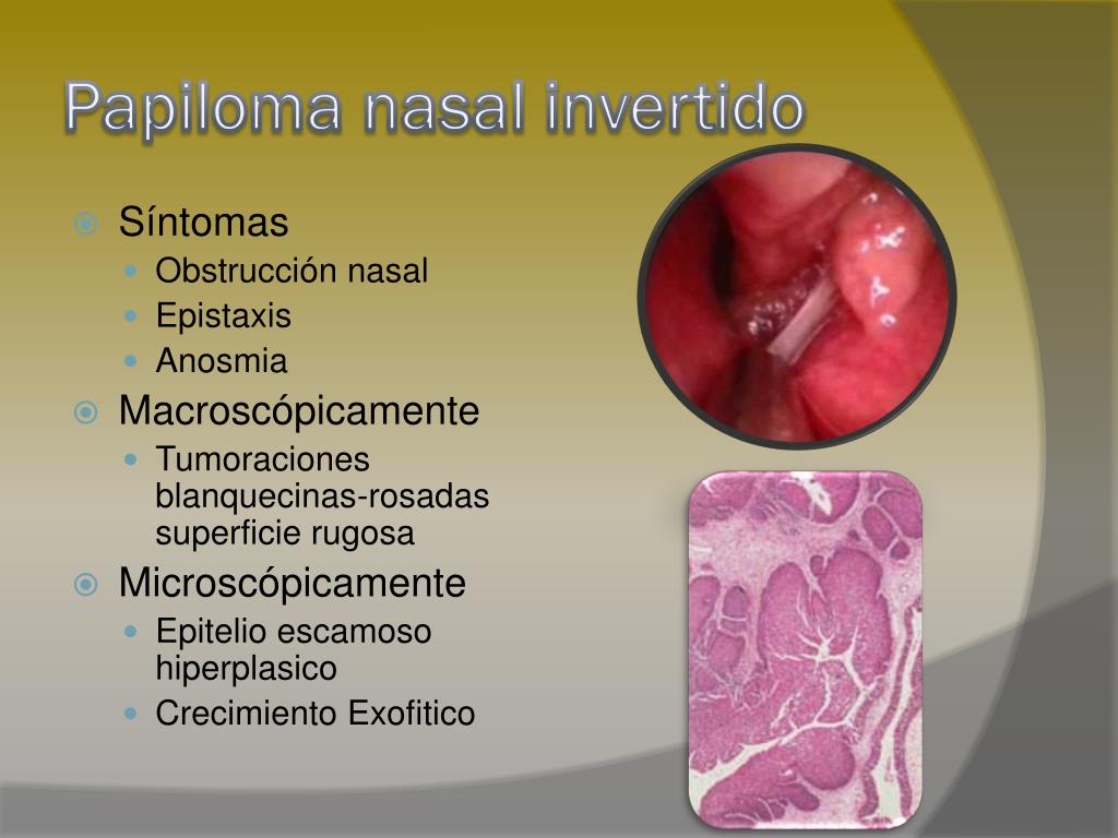Papiloma tabique nasal