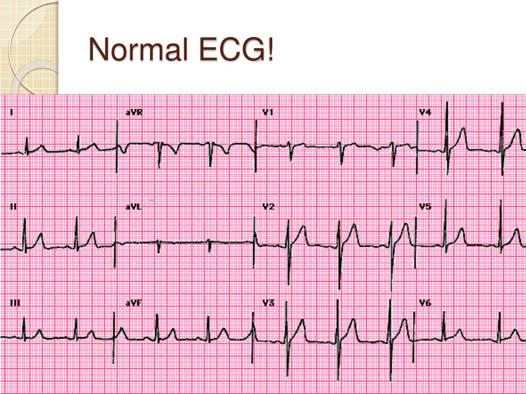 8. EKG Heartbeat French Tips - wide 6