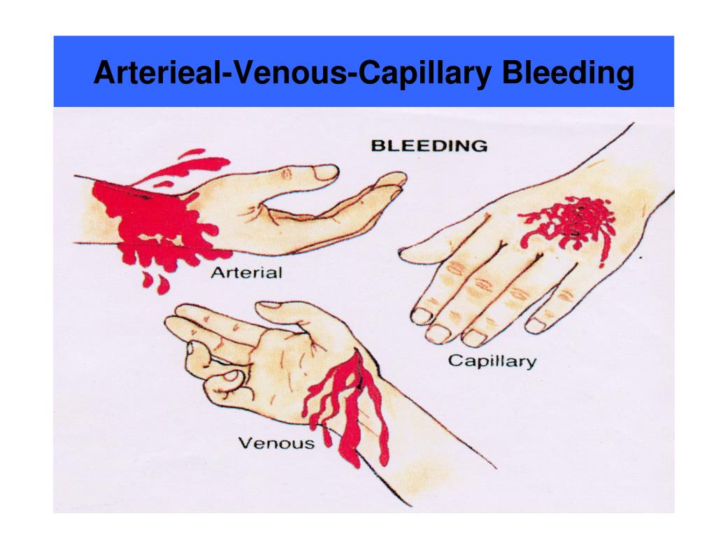 How To Spot Arterial Bleeding Quick Cpr - vrogue.co - How Long Does It Take To Bleed Out