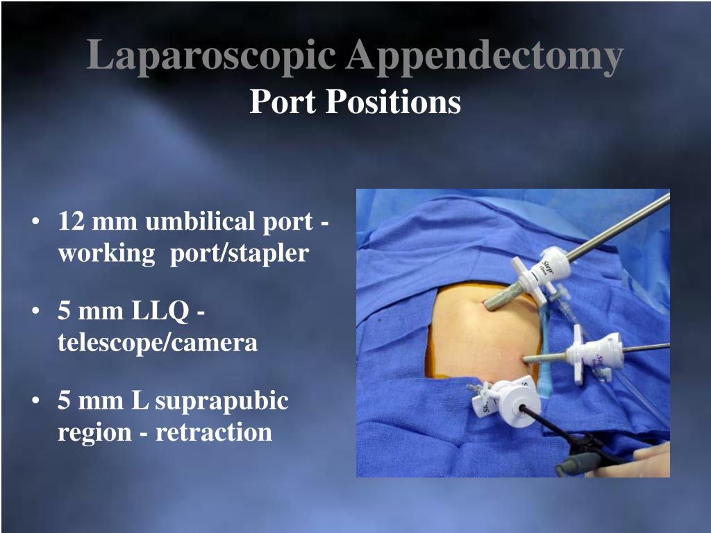 Laparoscopic Appendectomy Steps