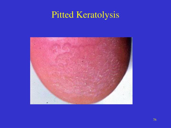 PPT Bacterial Infections Chapter 14 PowerPoint Presentation ID1932