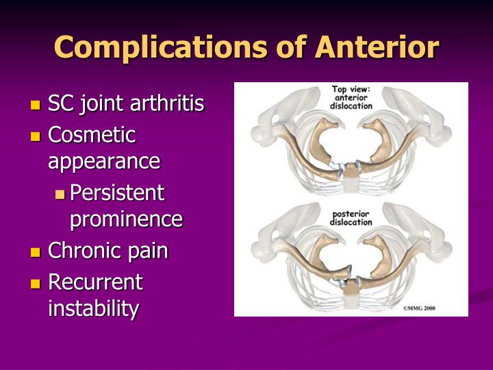 Ppt Sternoclavicular Joint Dislocation Powerpoint Presentation Id