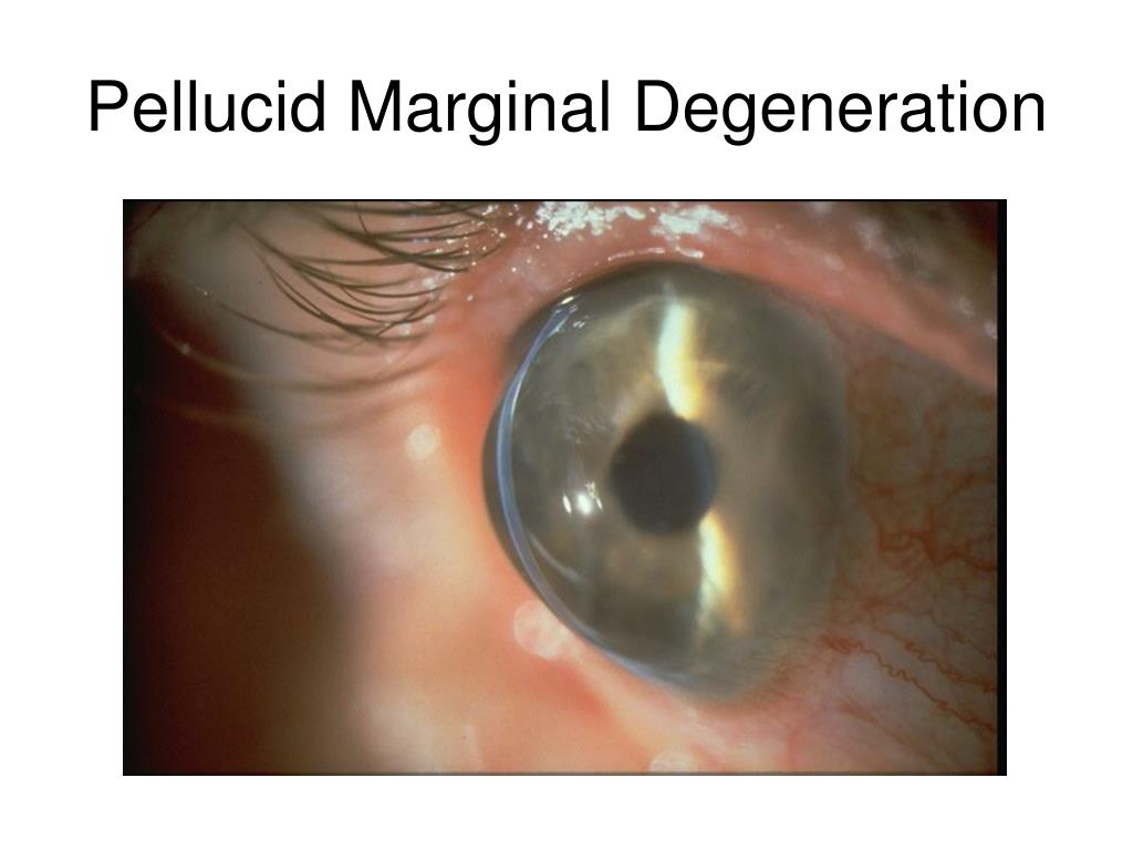 keratoconus vs pellucid marginal degeneration keratoconus vs pellucid marginal degeneration