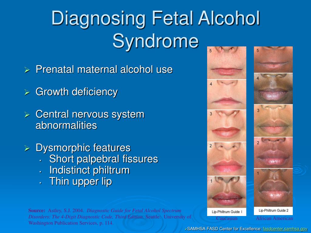 Diagnosing Fetal Alcohol Syndrome.