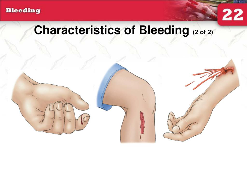 PPT - 22: Bleeding PowerPoint Presentation, free download - ID:204031