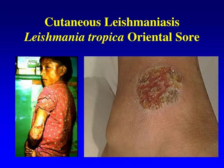 cutaneous leishmaniasis leishmania tropica oriental sore n.