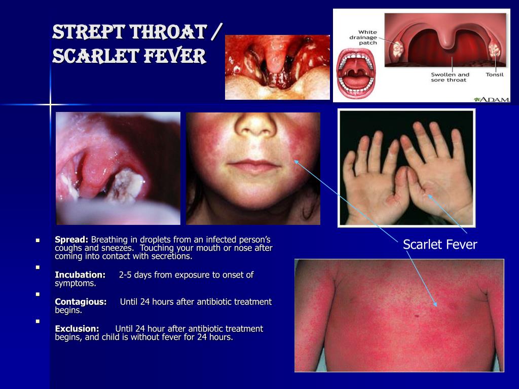 Ppt Common Childhood Diseases Powerpoint Presentation Free Download