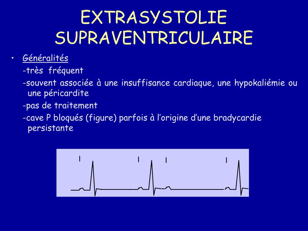 PPT - TROUBLES DU RYTHME A LA PHASE AIGUE DE L’INFARCTUS PowerPoint ...