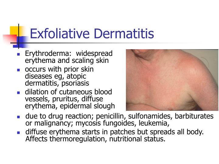 Ppt Non Infectious Skin Diseases Powerpoint Presentation Id210732