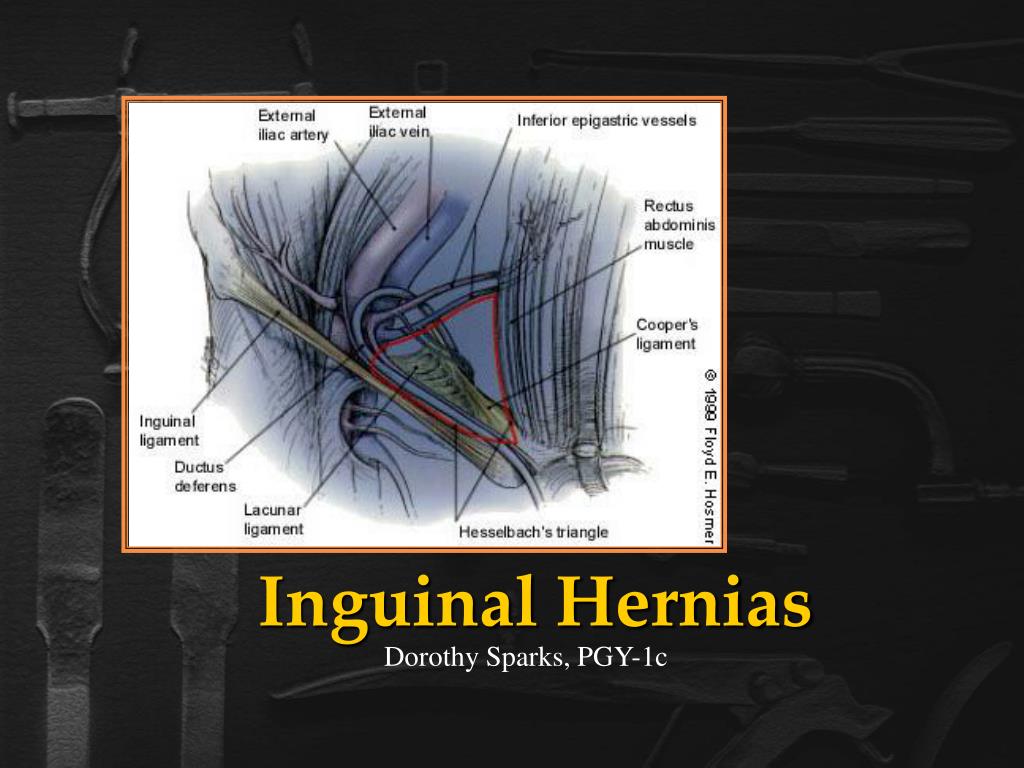 Inguinal Hernia Presentation