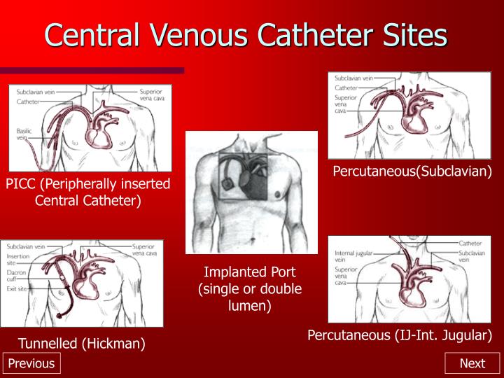 Percutaneous Central Venous Catheter