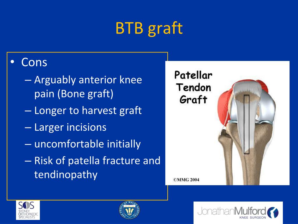 PPT Sports Knee Surgery ACL Graft Choice PowerPoint Presentation 