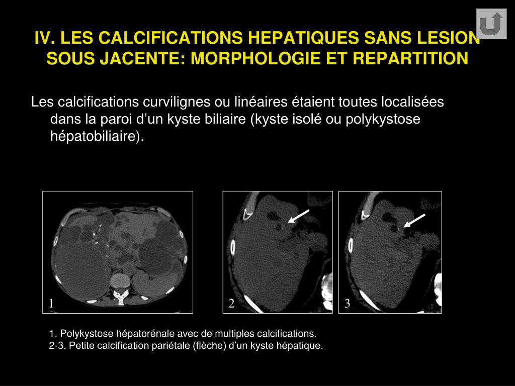 PPT - LES CALCIFICATIONS HÉPATIQUES AU SCANNER : ANALYSE SÉMÉIOLOGIQUE ...