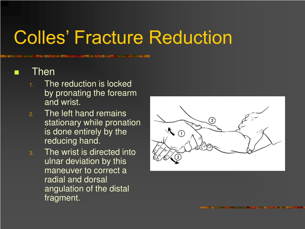 PPT Dislocation And Fracture Reductions PowerPoint Presentation Free PPT Dislocation And Fracture Reductions PowerPoint Presentation Free