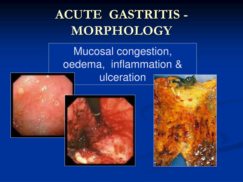 gastritis presentation