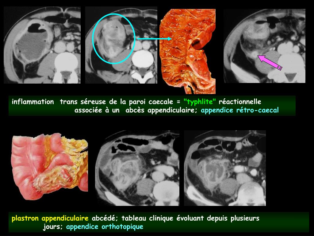 PPT - pourquoi le scanner dans l'appendicite aiguë et ses complications ?  PowerPoint Presentation - ID:228514