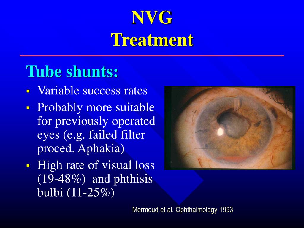 PPT Neovascular Glaucoma (NVG) PowerPoint Presentation,, 43% OFF