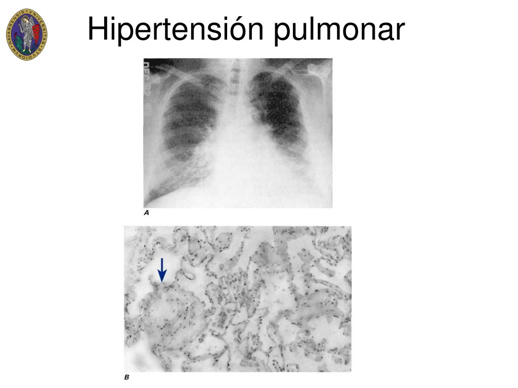 PPT - Hipertensión pulmonar Cor pulmonale PowerPoint..