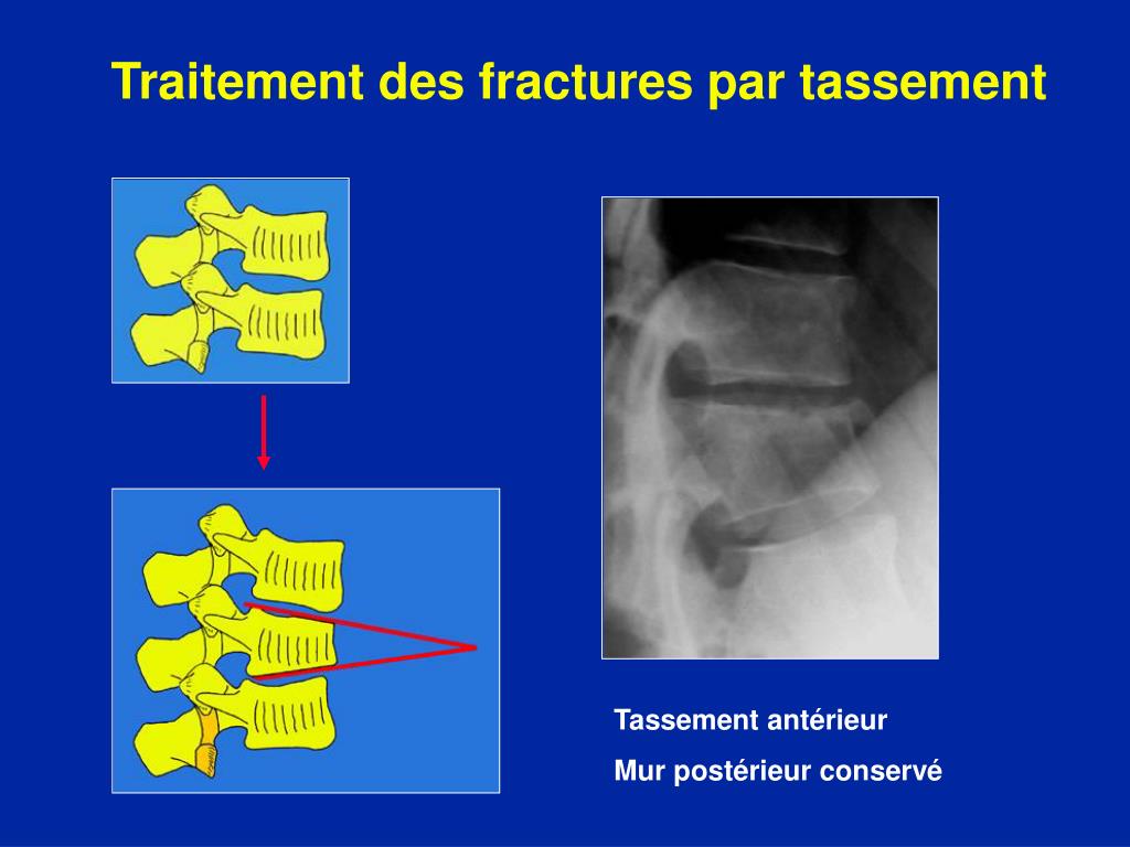 PPT - Fractures Dorsales et Lombaires PowerPoint Presentation, free  download - ID:230363