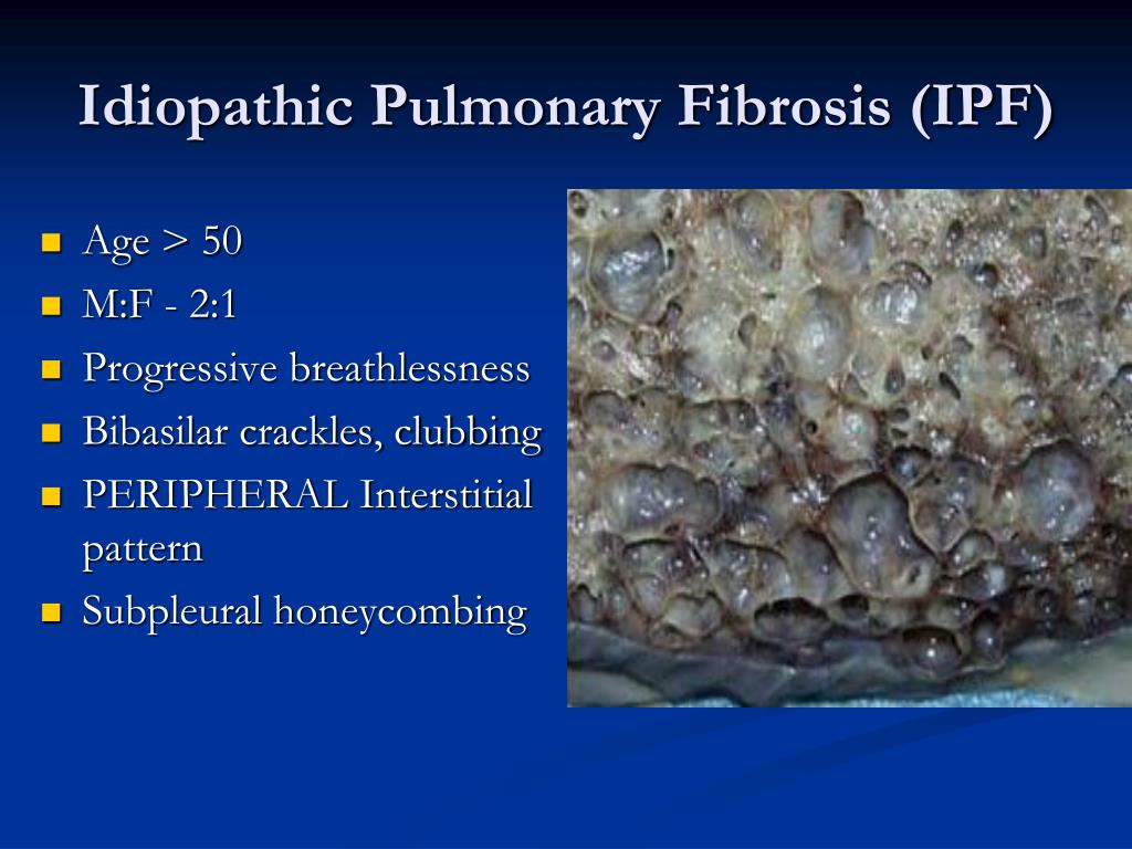 pulmonary fibrosis case presentation ppt