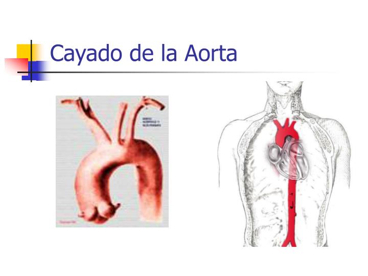 Qué Es El Cayado Aórtico _ Aneurisma aórtico: qué es, síntomas y ...