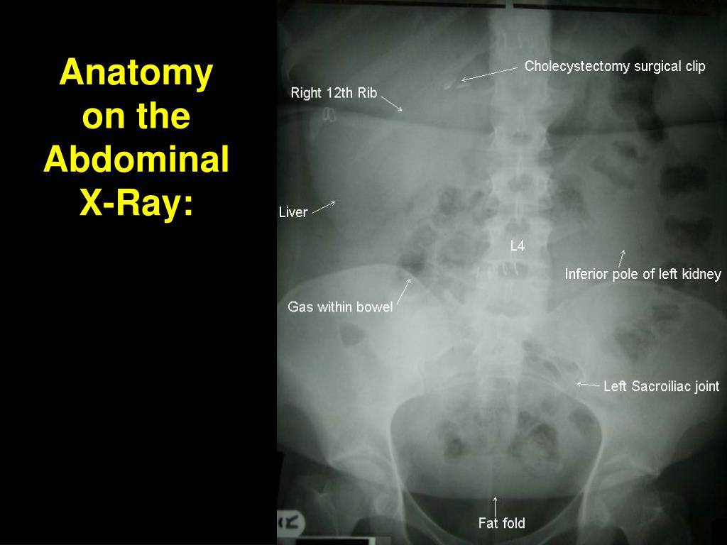 Ppt The Abdominal X Ray Powerpoint Presentation Free Download Id 23266