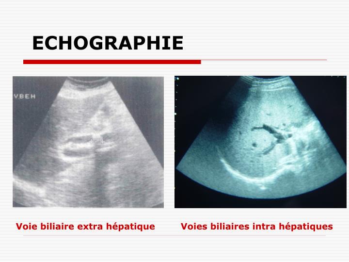 Dilatation Des Voies Biliaires Intra Et Extra-hépatiques PPT - ICTERES CHIRURGICAUX PowerPoint Presentation - ID:235203
