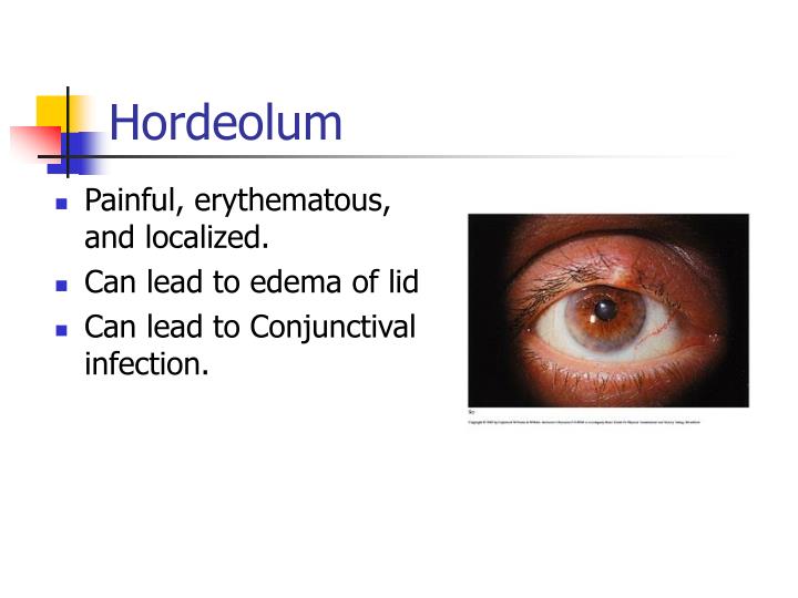 Hordeolo PPT - The Differential Diagnosis of The Red Eye PowerPoint Presentation ...