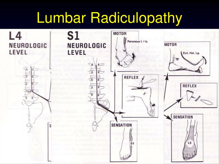 Lumbar Disc Herniation With Radiculopathy