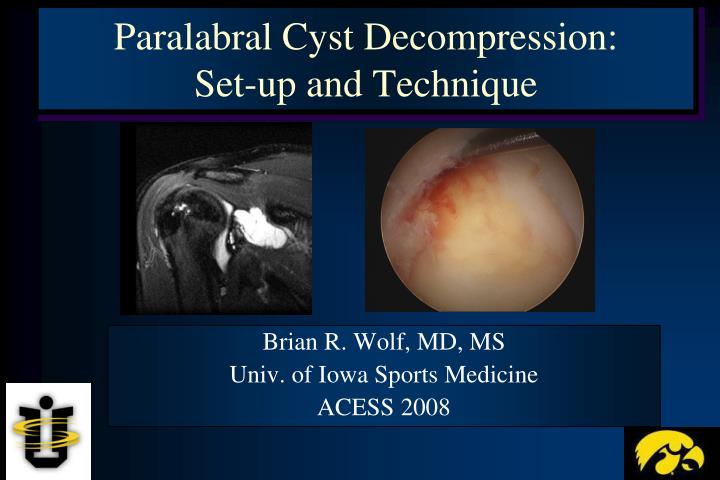 Ppt Paralabral Cyst Decompression Set Up And Technique Powerpoint