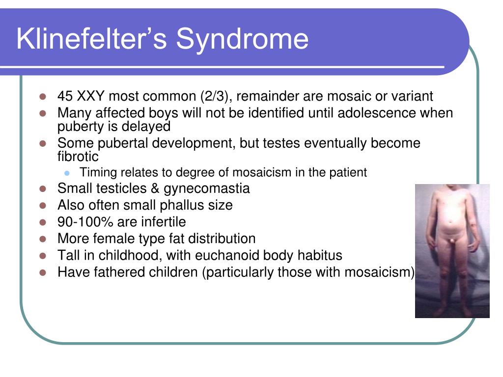 Androgen insensitivity syndrome as related to Klinefelter syndrome ...